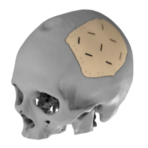 Implante Craneal 3D de Peek